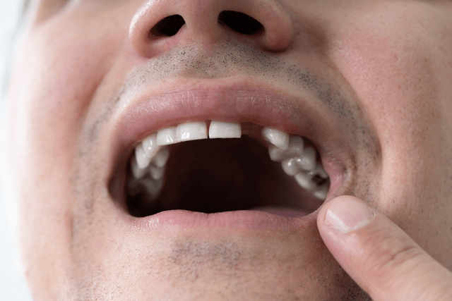 Dental Bridges Near You