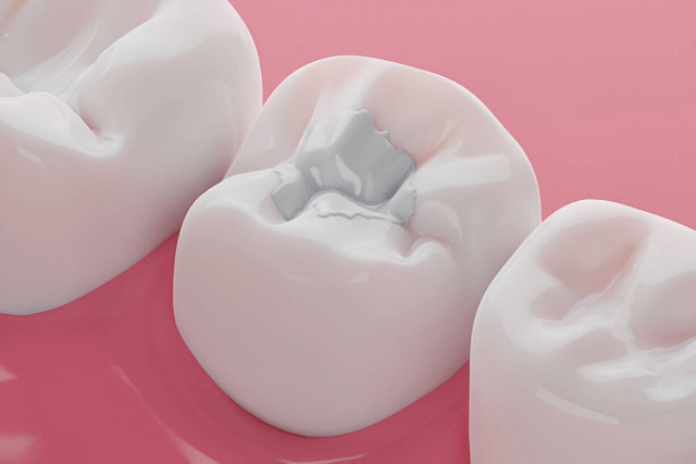 Dental Fillings Near You