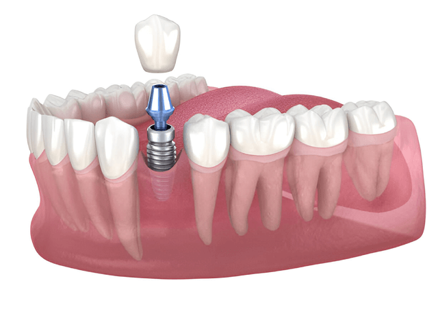 Dental Implants Near You