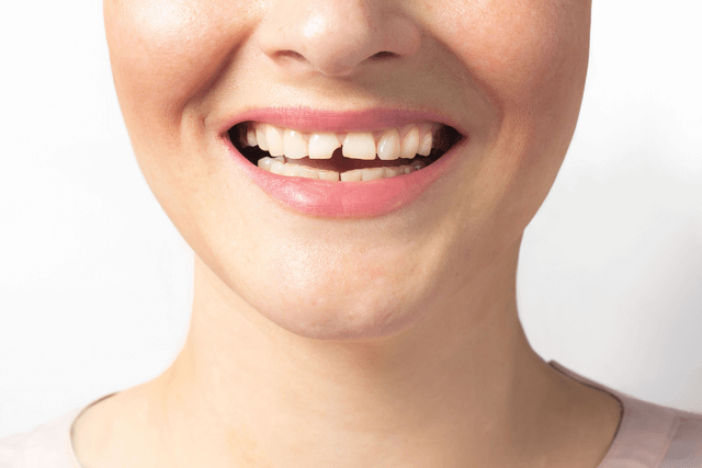 Dental Veneers Near You