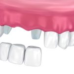 whats the difference between a 2 tooth and 3 tooth bridge