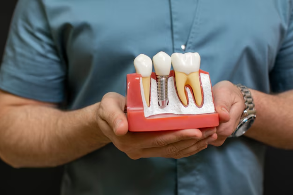 Why Dental Implants are a Better Option than Dentures