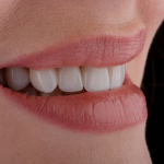 Can Veneers Fix Gapped Teeth?