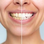 get a brighter smile with professional teeth whitening