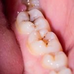 why does food keep getting stuck between my teeth?